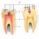 Model zubního onemocnění - 2x zvětšeno - 21 částí