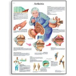 Schéma - artritida - 50x67 cm