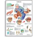 Schéma - artritida - AJ - 50x67 cm