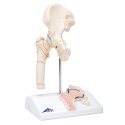 Model lidského kyčelního kloubu se zánětem a zlomeninou stehenní kosti
