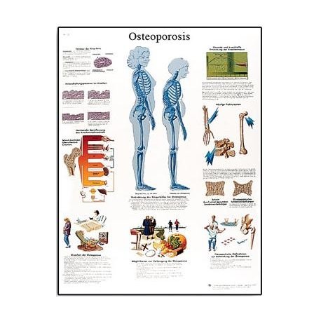 Schéma - osteoporóza - AJ - 50x67 cm