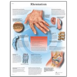 Schéma - revmatoidní artritida - AJ - 50x67 cm