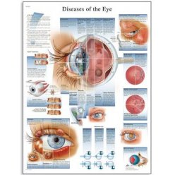 Schéma - nemoci lidského oka - AJ - 50x67 cm