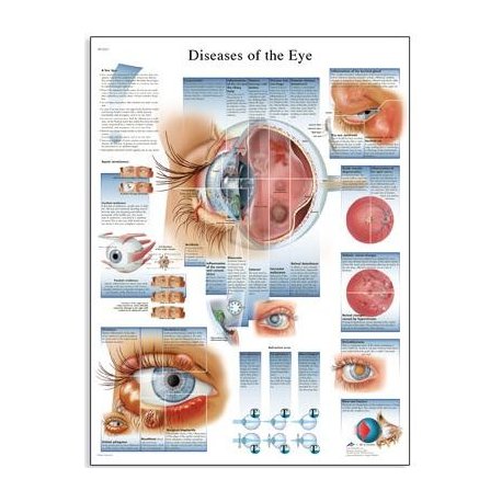Schéma - nemoci lidského oka - AJ - 50x67 cm