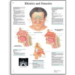 Schéma - rinitida a sinusitida - AJ - 50x67 cm