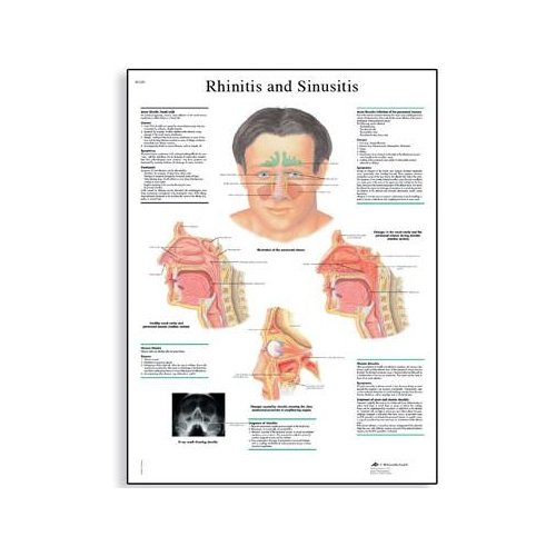 Schéma - rinitida a sinusitida - AJ - 50x67 cm