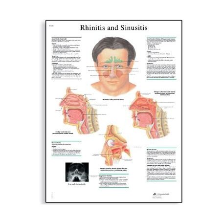 Schéma - rinitida a sinusitida - AJ - 50x67 cm