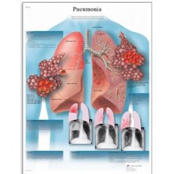 Schéma - pneumonie - AJ - 50x67 cm