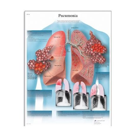 Schéma - pneumonie - AJ - 50x67 cm