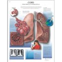 Schéma - chronická obstrukční plicní nemoc - AJ - 50x67 cm - DOPRODEJ