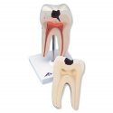 Model lidského zubu - spodní stolička s dvojitým kořenem a kazem - 2 části
