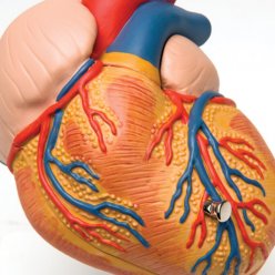 Model lidského srdce s hypertrofií levé komory - 2 části