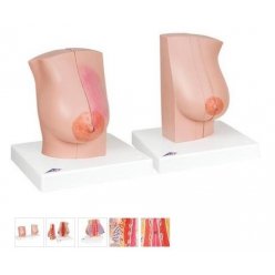 Model ženského prsu s onemocněním
