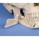 Model lidské lebky - dentální - zaklíněný zub moudrosti