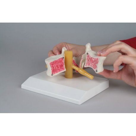 Model obratle s osteoporózou - rozložený
