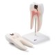 Model lidského zubu - spodní stolička s dvojitým kořenem a kazem