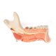 Model poloviny lidské dolní čelisti s nemocnými zuby