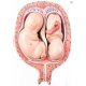 Model plodů dvojčat v pátém měsíci těhotenství