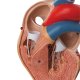 Model lidského srdce s hypertrofií levé komory - 2 části