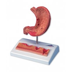 Model lidského žaludku s vředy