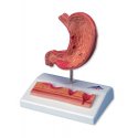 Model lidského žaludku s vředy
