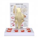 Model přetržení menisku kolenního kloubu