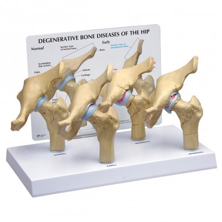 Čtyři stádia osteoartritidy kyčelního kloubu
