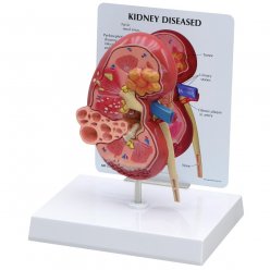 Model lidské ledviny - anatomický - s onemocněním