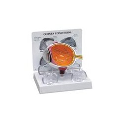 Model oka s onemocněním rohovky