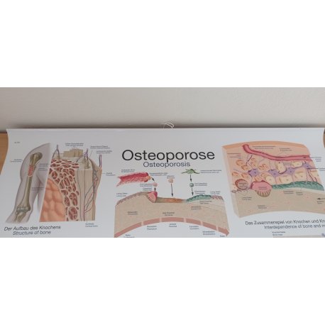 Schéma - osteoporóza