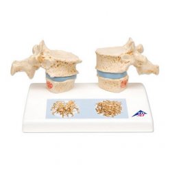 Model dvou lidských hrudních obratlů s osteoporózou